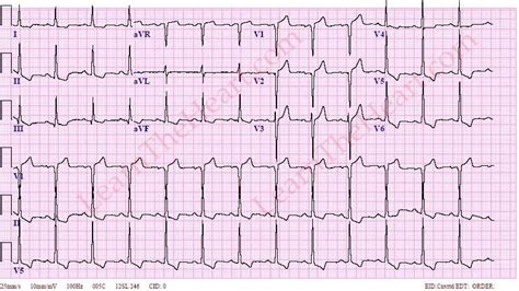 lv hypertrophy on ecg|left ventricular hypertrophy with repolarization abnormality.